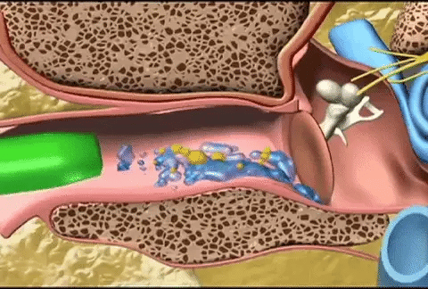 Limpiador eléctrico aspirando el cerumen del oído