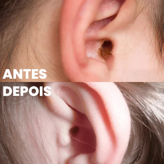 Oído antes y después de la limpieza